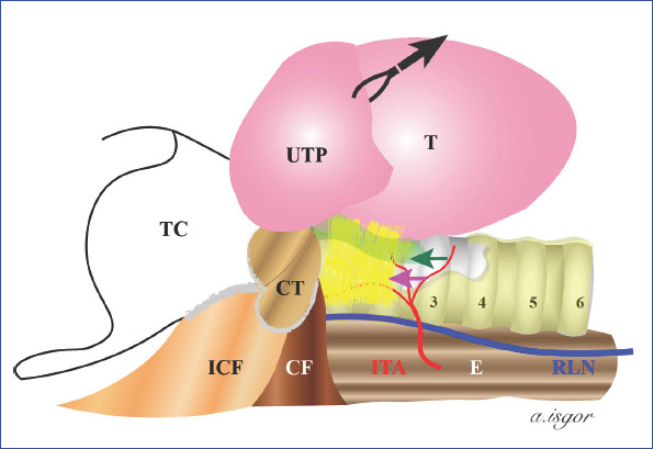 Illustration showing the lateral approach to recurrent laryngeal nerve identification during thyroidectomy