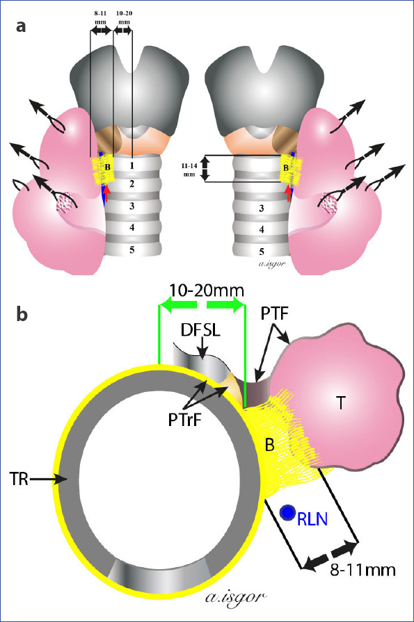 Illustration showing the medial approach to recurrent laryngeal nerve identification during thyroidectomy