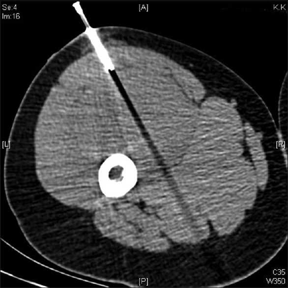 CT-guided core needle biopsy of a soft tissue mass demonstrating proper biopsy technique