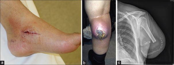 Examples of inappropriate sarcoma excisions showing disrupted tissue planes and contaminated margins