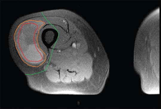 MRI showing planned surgical margins around a soft tissue sarcoma with anatomic boundaries