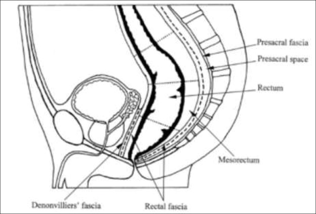 Diagram showing the anatomical planes of dissection during total mesorectal excision for rectal cancer
