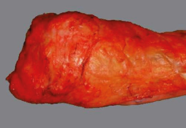 Photograph showing complete total mesorectal excision specimen with intact mesorectal fascia