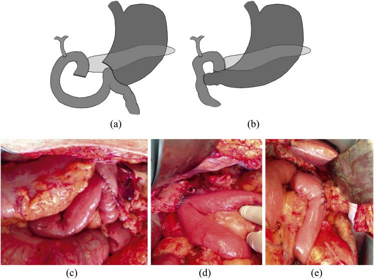 Diagram showing post-operative anatomy after pancreaticoduodenectomy with the three reconstruction anastomoses
