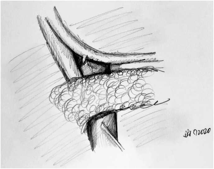 Intraoperative illustration showing identification and ligation of the gastroduodenal artery during Whipple procedure