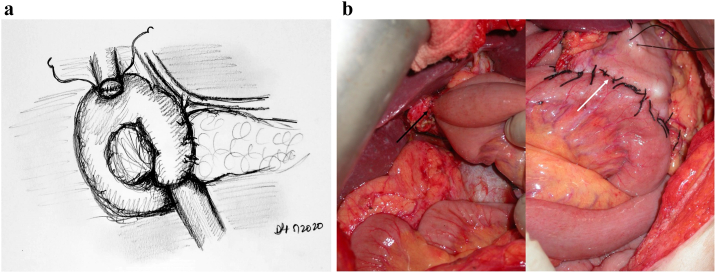 Illustration showing the reconstruction phase of pancreaticoduodenectomy with hepaticojejunostomy and gastrojejunostomy