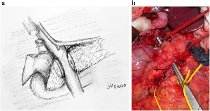 Intraoperative illustration showing pancreatic transection at the neck during Whipple procedure