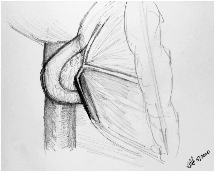 Illustration showing medial visceral rotation and Kocher maneuver during pancreaticoduodenectomy
