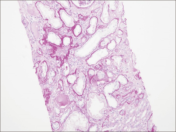 Interstitial fibrosis and tubular atrophy (IF/TA) in chronic allograft injury