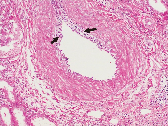 Intimal arteritis in transplant rejection showing lymphocytic infiltration beneath the endothelium