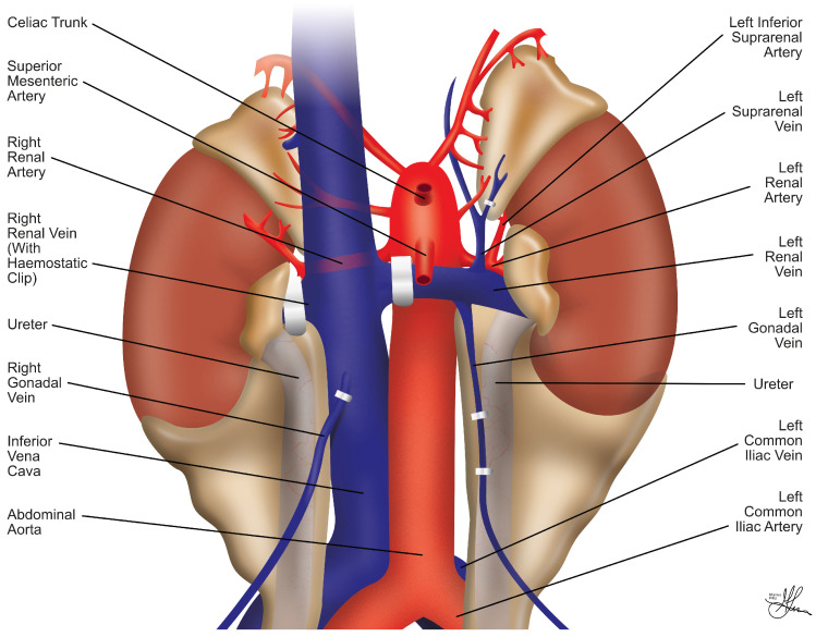 Bench preparation of donor kidney showing vascular reconstruction and ureteral trimming