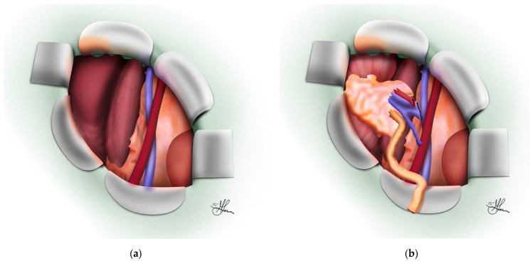 Kidney transplant placement in the right iliac fossa showing retroperitoneal positioning