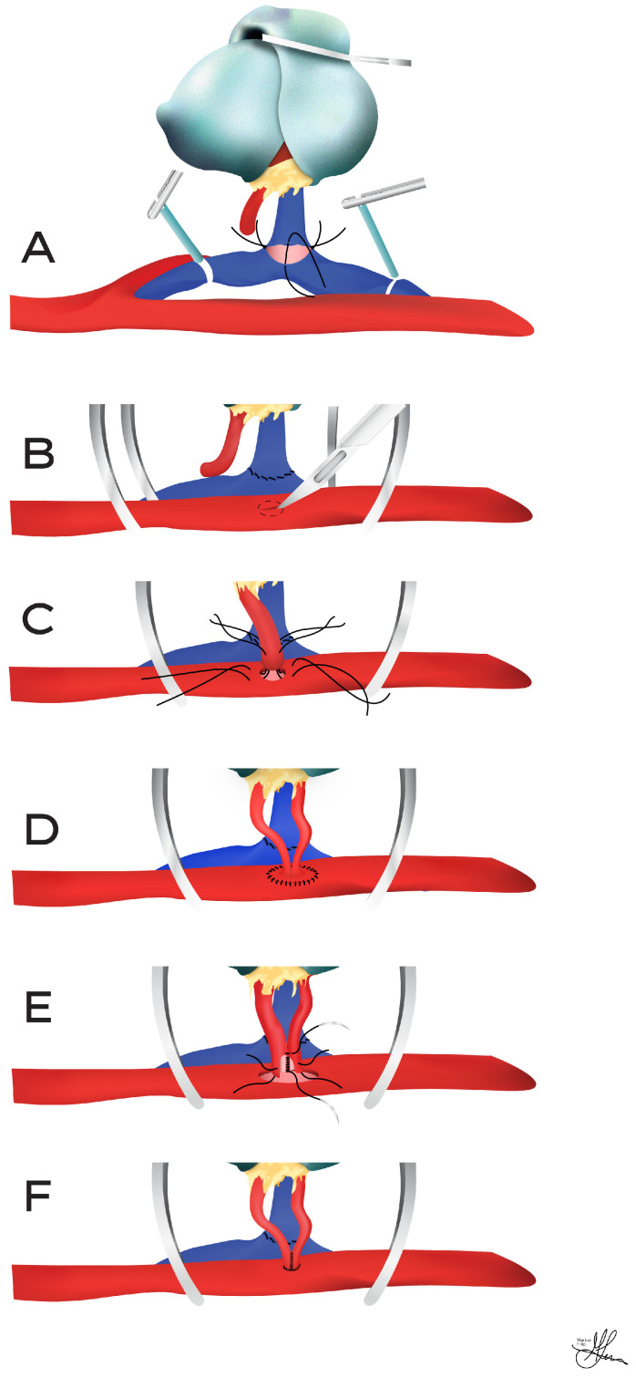 Kidney transplant vascular anastomoses showing renal artery and vein to external iliac vessels