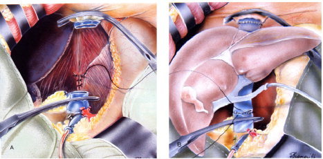 Liver transplant vascular and biliary anastomoses showing portal vein, hepatic artery, and bile duct connections