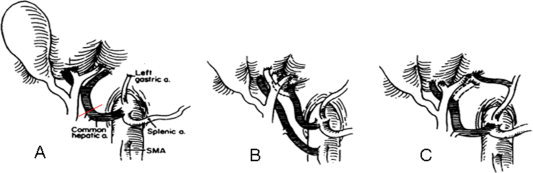 Hepatic artery blood supply to bile ducts showing why thrombosis causes biliary necrosis