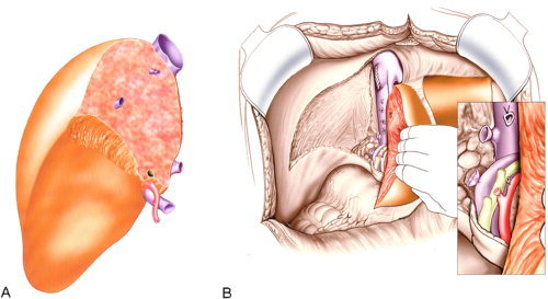 Living donor liver transplant showing right lobe graft segments V-VIII and left lateral segment II-III