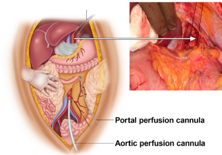 Multi-organ procurement surgical technique showing aortic cannulation and cold flush sequence