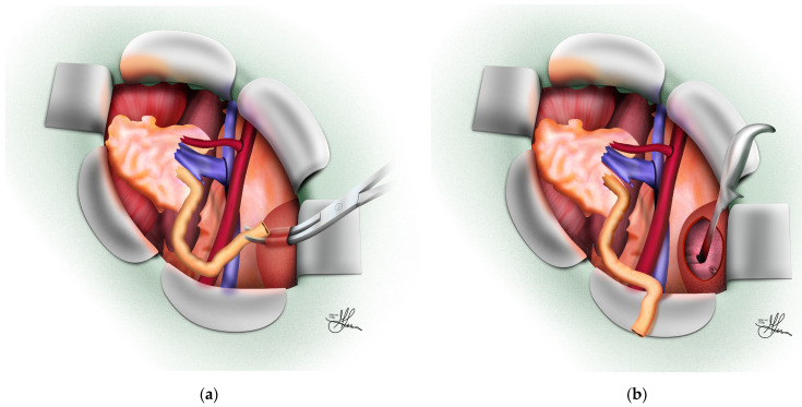 Lich-Gregoir ureteroneocystostomy technique with submucosal tunnel anti-reflux mechanism