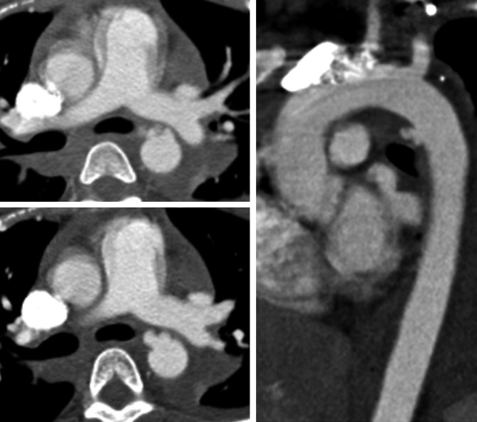 CT angiography showing traumatic aortic pseudoaneurysm at the aortic isthmus