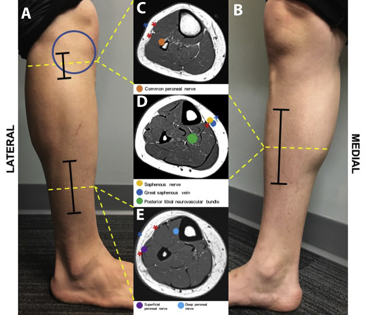 Cross-sectional anatomy of the lower leg showing four fascial compartments