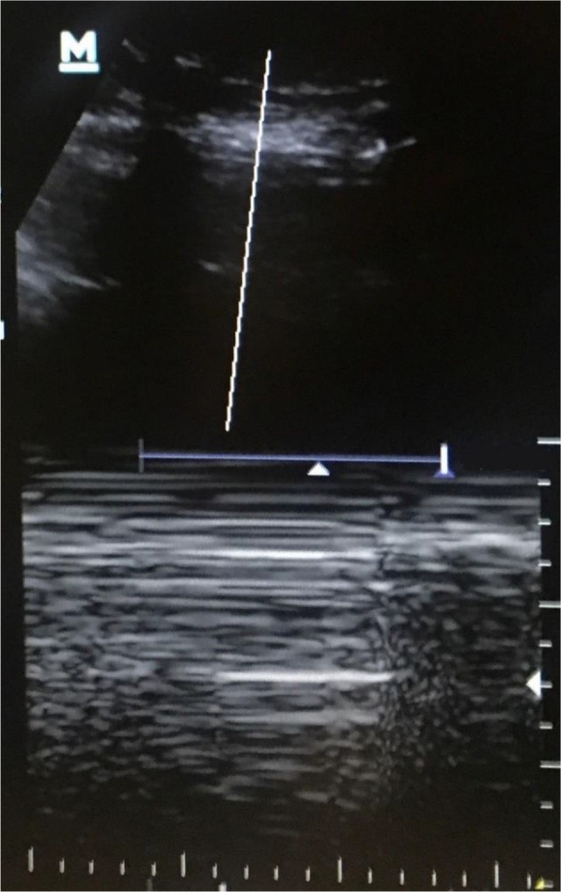 eFAST barcode sign on M-mode indicating pneumothorax with absent lung sliding