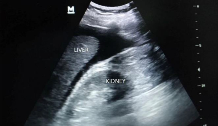 Positive eFAST examination showing free fluid in the right upper quadrant Morrison's pouch