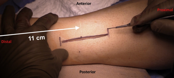 Lower leg fasciotomy two-incision technique showing lateral and medial approaches to four compartments