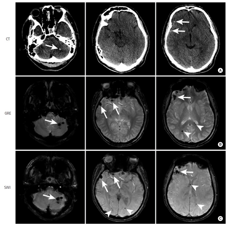 CT scan showing bilateral hemorrhagic parenchymal contusions in traumatic brain injury