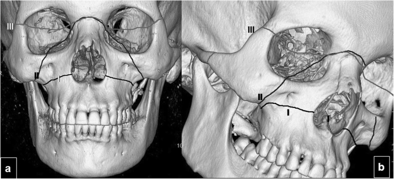 Le Fort fracture classification showing types I II and III fracture lines on facial skeleton