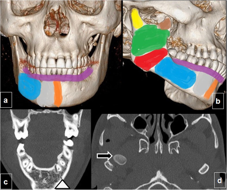 Mandible anatomy showing common fracture sites including condyle body and angle with CT example