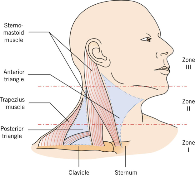 Zones of the neck for penetrating trauma — Zone I, II, and III anatomical boundaries