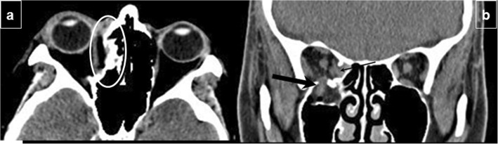 Orbital blowout fracture CT coronal view showing orbital floor defect with herniation into maxillary sinus