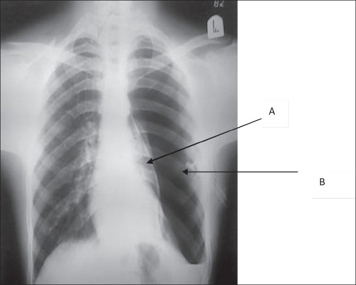 Chest X-ray showing tension pneumothorax with mediastinal shift and collapsed lung