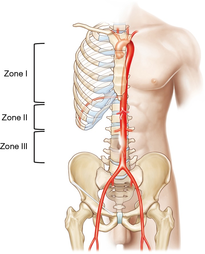 Illustration of REBOA and resuscitative thoracotomy aortic occlusion zones and technique
