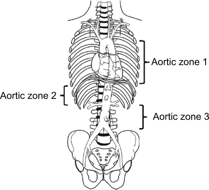 REBOA aortic zones I II III showing balloon occlusion positions relative to abdominal vasculature