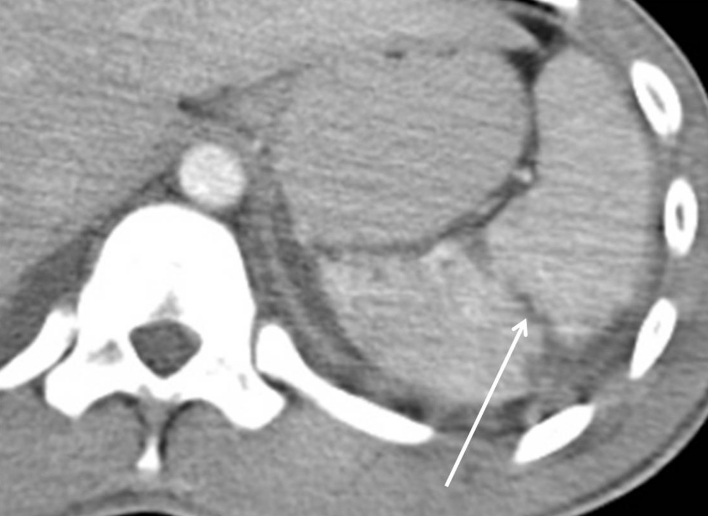 CT scan showing splenic laceration with active contrast extravasation in blunt abdominal trauma
