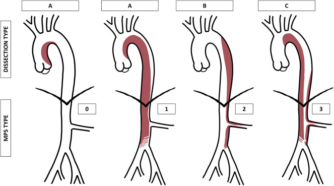 Classification diagram of acute aortic dissection showing Stanford Type A and Type B with anatomic extent illustrated