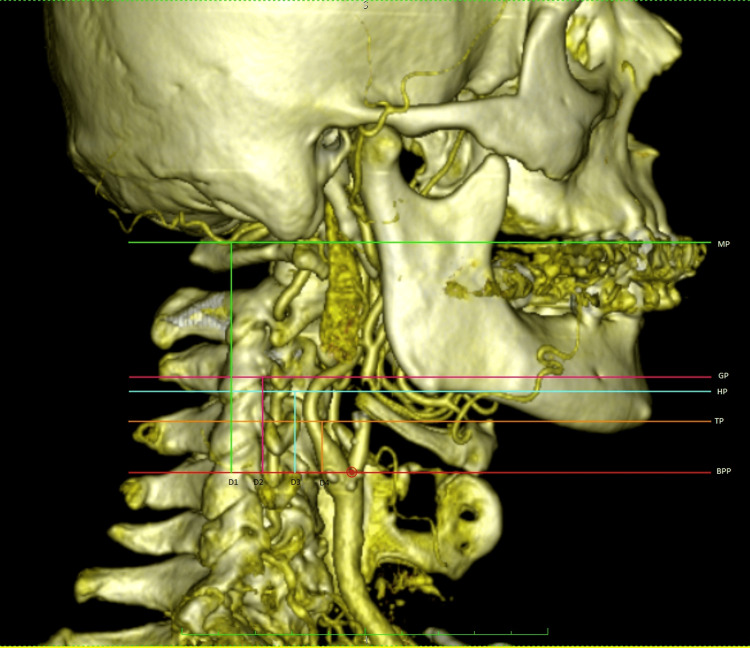 CT angiography showing the carotid bifurcation distance and position relative to cervical vertebral landmarks