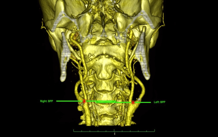 CTA showing variability of carotid bifurcation level relative to cervical vertebrae from C2 to C5