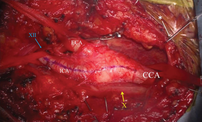 Intraoperative photograph of carotid endarterectomy showing exposed carotid bifurcation with common carotid artery, internal carotid artery, and external carotid artery labeled