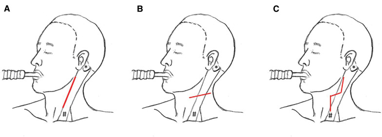 Surgical skin incision markings for carotid endarterectomy along the anterior border of sternocleidomastoid muscle