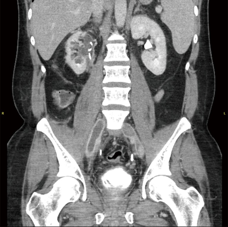 CT venography showing bilateral common iliac vein thrombi as hypodense occlusive masses
