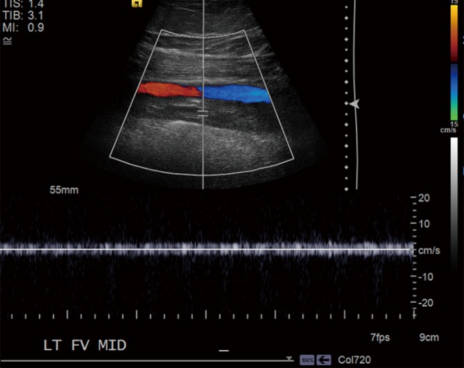 Color-flow Doppler ultrasound showing complete occlusion of the left femoral vein by a heterogeneous thrombus