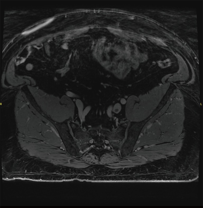 MR venography showing focal thrombus in the left common iliac vein with surrounding venous anatomy