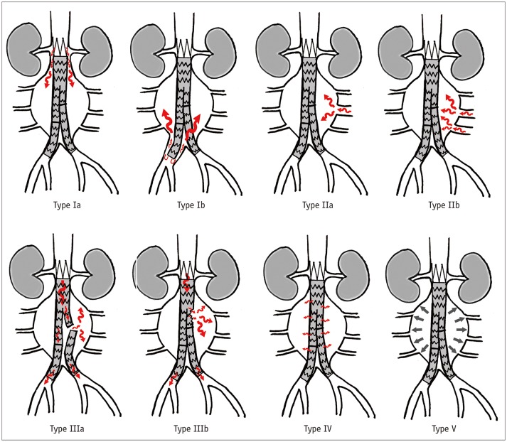 Diagram illustrating the five types of endoleak after EVAR with arrows showing blood flow patterns for each type
