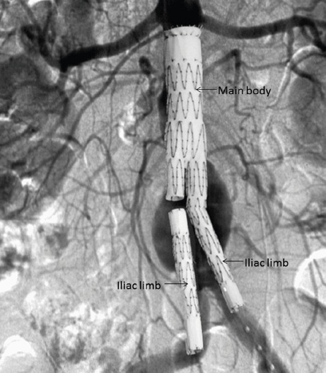 Diagram of bifurcated stent-graft components used in endovascular aneurysm repair showing main body, limbs, and deployment mechanism
