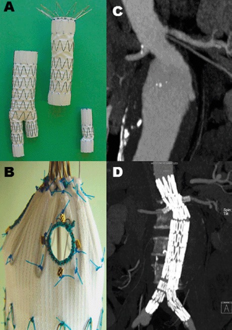 Fenestrated stent-graft showing fenestrations aligned with renal and visceral arteries for juxtarenal aneurysm repair