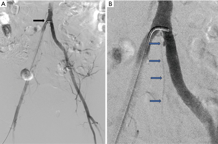 Angiographic anatomy of the aortic bifurcation and iliac arteries showing the common iliac, external iliac, and internal iliac branching pattern