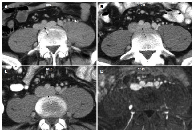 CT and MR imaging demonstrating compression of the left common iliac vein by the right common iliac artery in May-Thurner syndrome