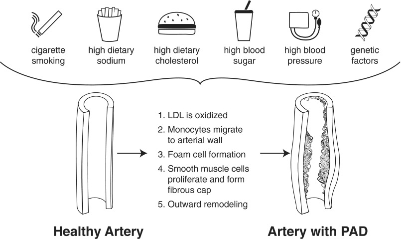 Diagram showing the pathogenesis of peripheral arterial disease including risk factors, endothelial dysfunction, and plaque progression